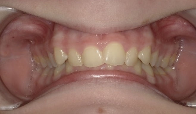 A picture of a patient with a severe deep bite