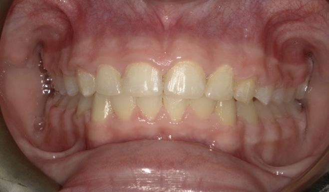An after image of the same deep-bite patient. Her teeth are corrected now