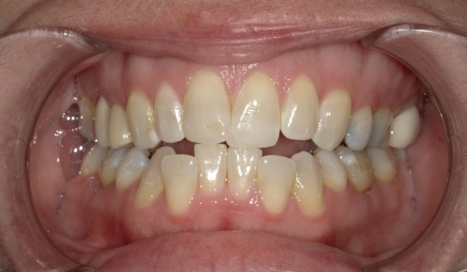 A before shot of a mouth with crowding and an anterior open bite