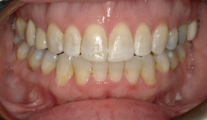The after shot of the anterior open bite mouth. The issues have been repaired