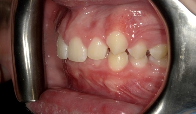 A Class II mouth with mild crowding and moderate overjet