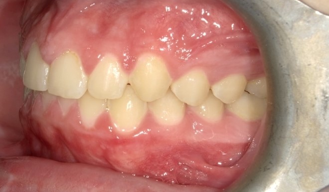 An after image of the Class II mouth with mild crowding and moderate overjet
