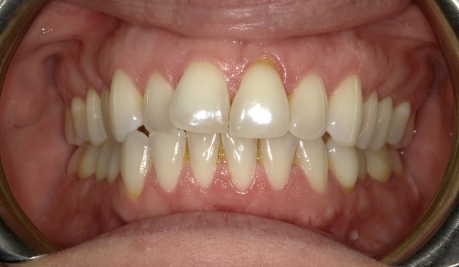 A mouth with upper crowding, anterior crossbite, spaces between teeth