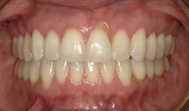 An after image of the mouth with upper crowding, anterior crossbite, spaces between teeth