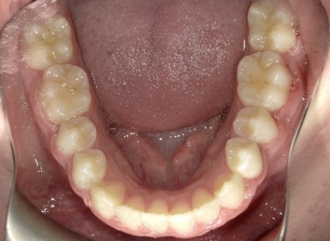An after image of the patients mouth. The crowns are gone and the teeth are straight