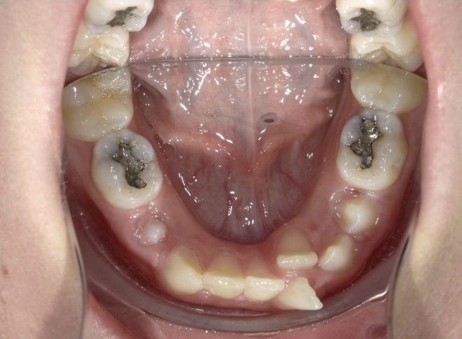 Before image of a patient's mouth. Several teeth have silver crowns. Several are crooked