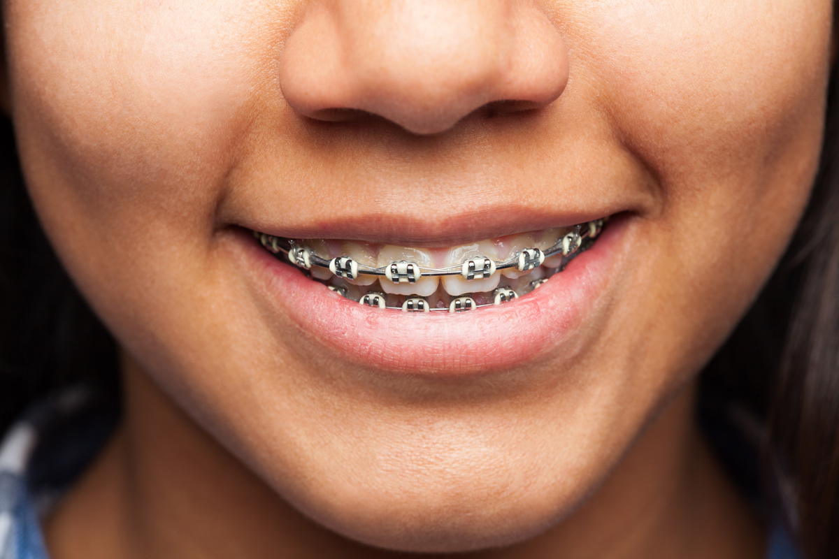girl with white banded braces