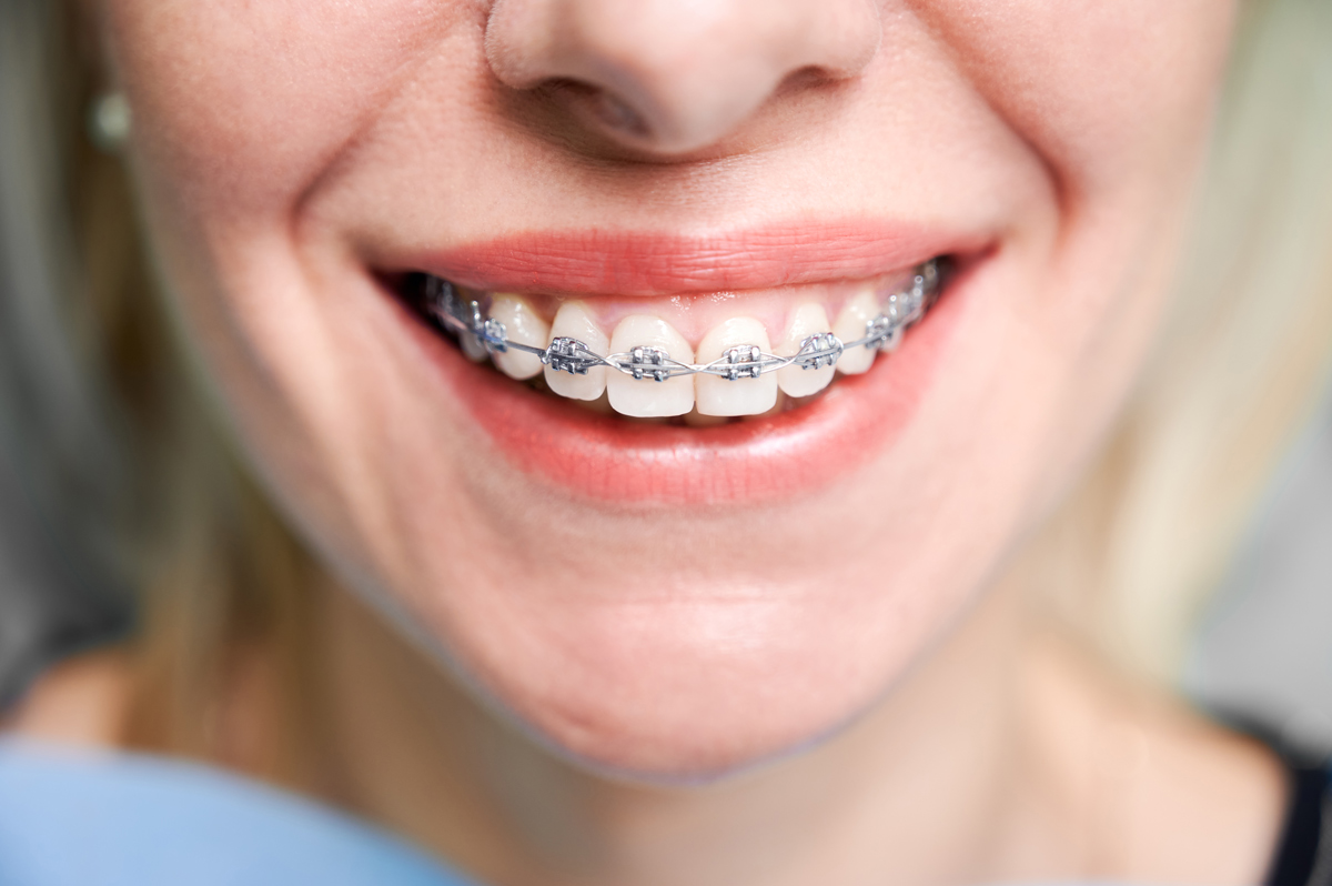 young woman in traditional braces