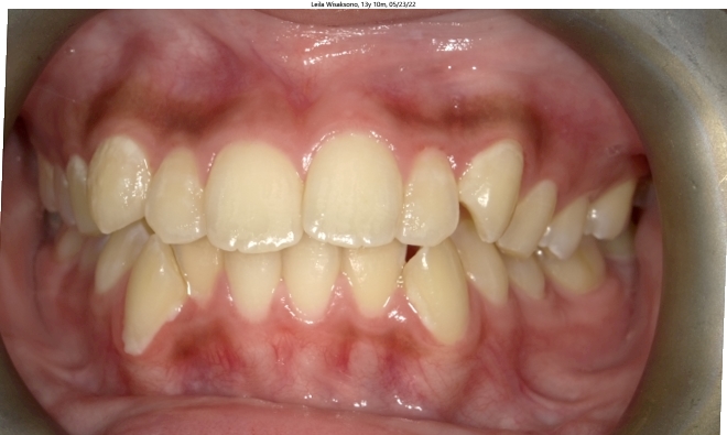 severe crowding and misaligned bite in female orthodontics patient