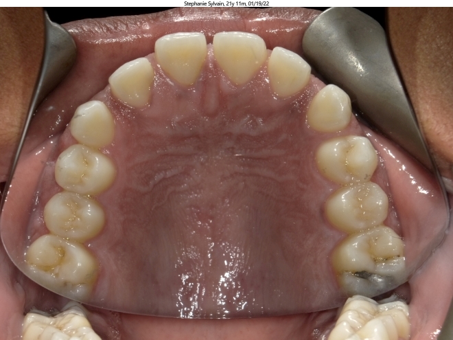 severe spacing issues in adult orthodontics patient