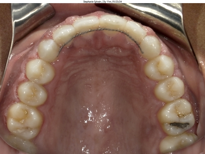 severe spacing issues in adult orthodontics patient corrected