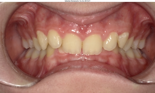 deep bite, moderate crowding, and malaligned bite in male orthodontics patient