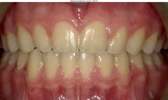 deep bite, moderate crowding, and malaligned bite in male orthodontics patient corrected