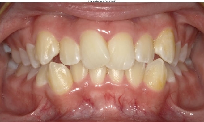 severe crowding in male orthodontics patient