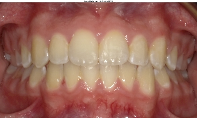 corrected overcrowding in male orthodontics patient