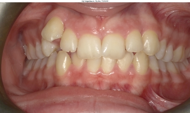 moderate crowding in female orthodontics patient