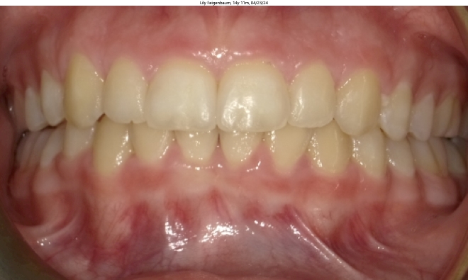 moderate crowding in female orthodontics patient corrected