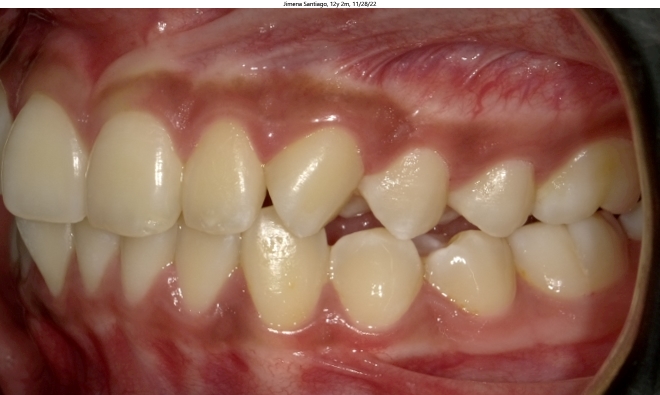 moderate crowding and misaligned bite in female orthodontics patient