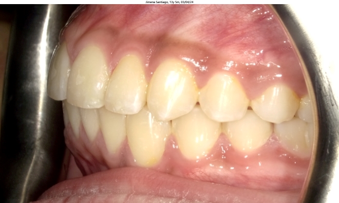 moderate crowding and misaligned bite in female orthodontics patient corrected