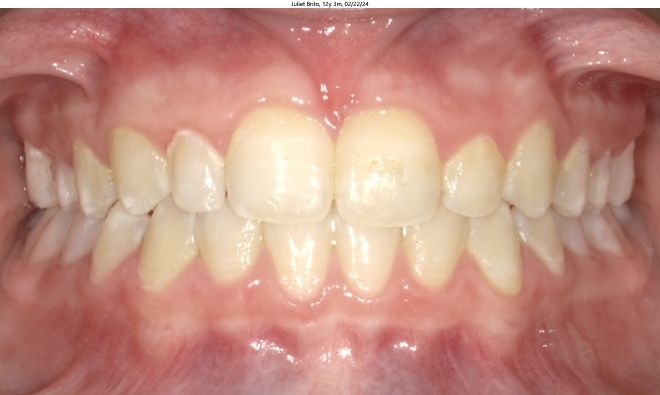 moderate crowding and deep bite in female invisalign patient corrected