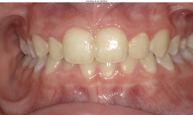 moderate crowding and deep bite in female invisalign patient