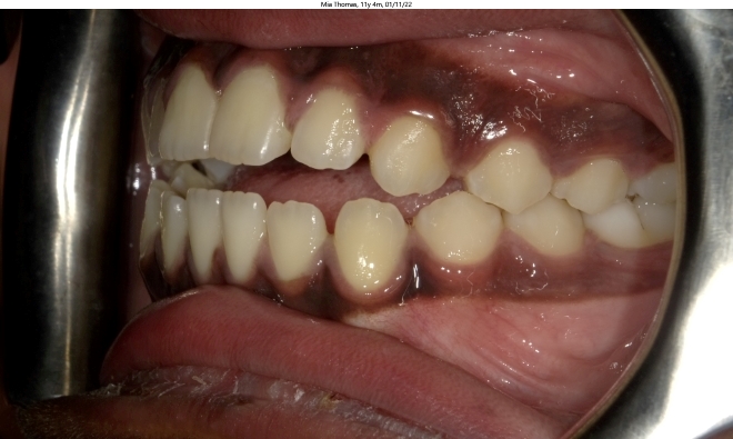 anterior open bite in female orthodontics patient