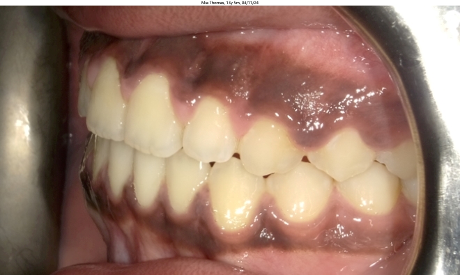 anterior open bite in female orthodontics patient corrected