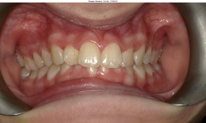 severe crowding, deep bite, overbite, in female orthodontics patient