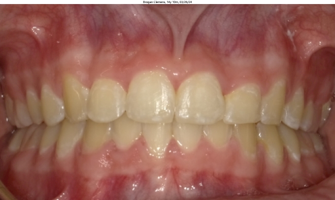 severe crowding, deep bite, overbite, in female orthodontics patient corrected