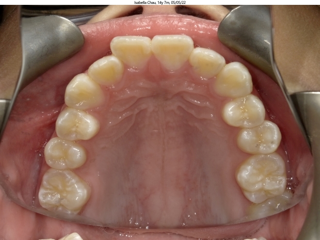 moderate crowding in female invisalign patient