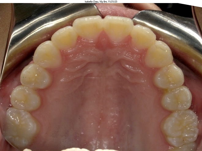 moderate crowding in female invisalign patient corrected