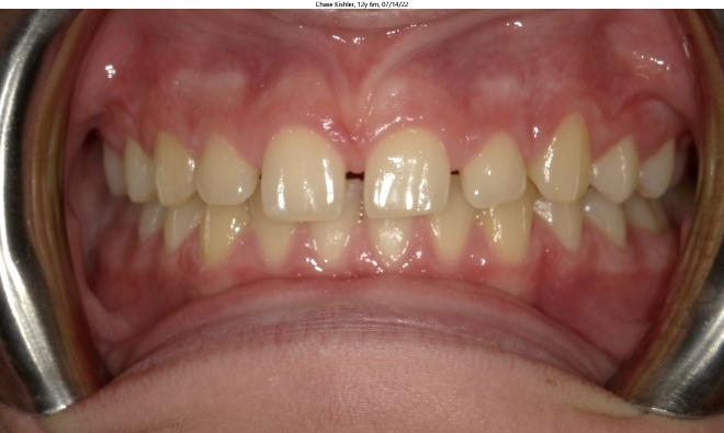 moderate spacing issues in male invisalign patient