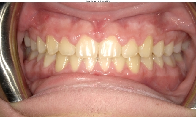 moderate spacing issues in male invisalign patient corrected