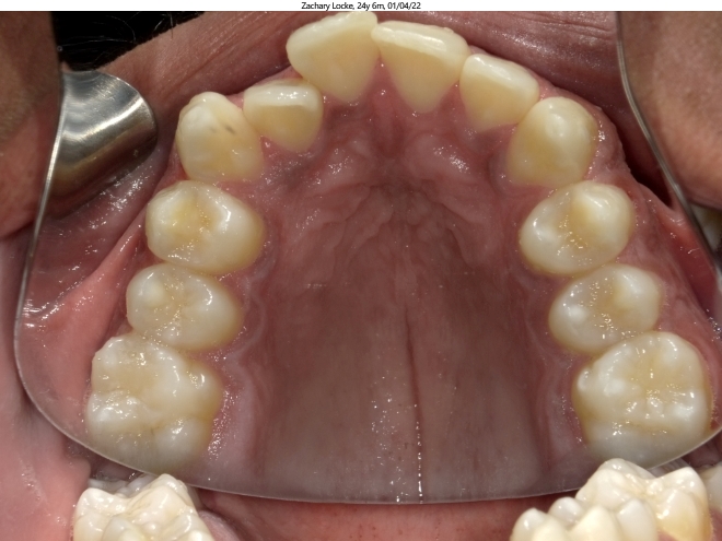 moderate spacing and anterior crossbite in adult orthodontics patient