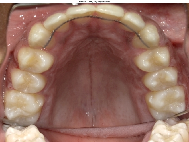 moderate spacing and anterior crossbite in adult orthodontics patient corrected