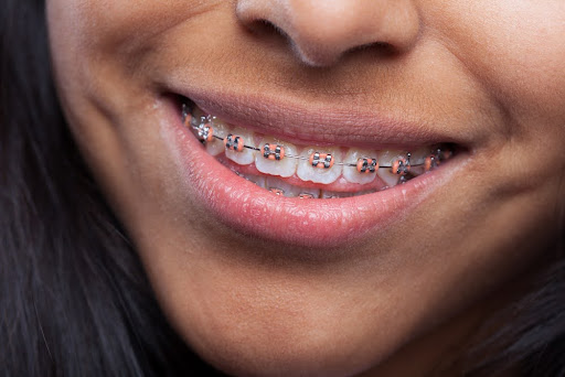 metal braces closeup how old is too old for braces callan orthodontics lawrenceville nj