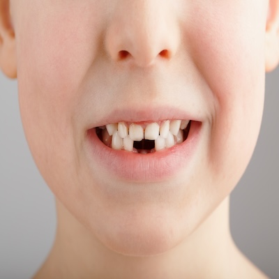 child with missing baby teeth callan orthodontics pediatric orthodontist in lawrenceville nj