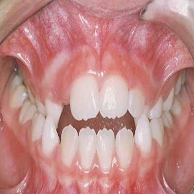 crossbite in patient mouth callan orthodontics pediatric orthodontist in lawrenceville nj