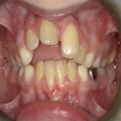 crooked teeth from tongue thrusting callan orthodontics pediatric orthodontist in lawrenceville nj
