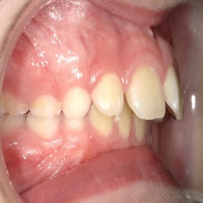 protruding front teeth in patient mouth callan orthodontics pediatric orthodontist in lawrenceville nj