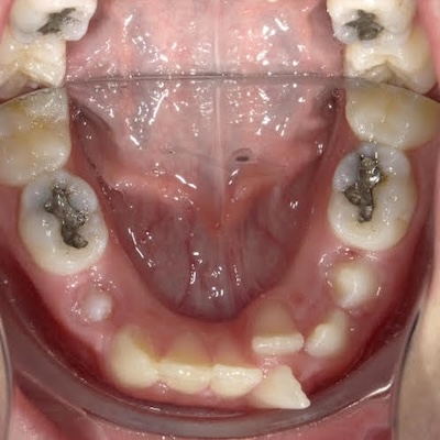 severe crowding in patient mouth callan orthodontics pediatric orthodontist in lawrencevilel nj
