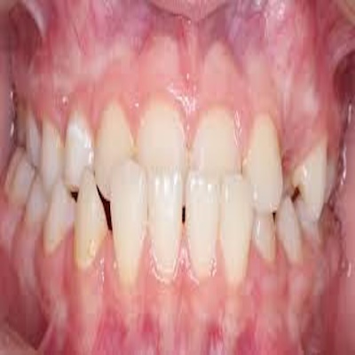 underbite in patient mouth callan orthodontics pediatric orthodontist in lawrenceville nj