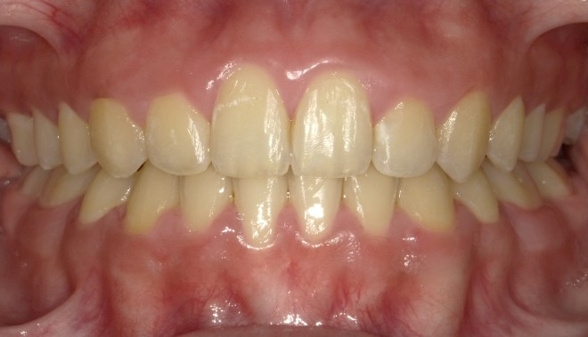 youth-crossbite-3-after