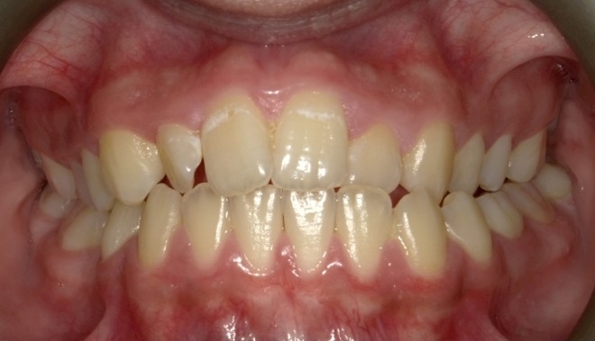 youth-crossbite-3-treatment