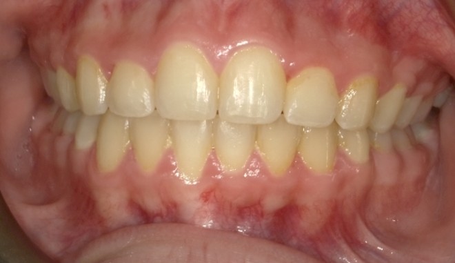 youth crossbite after part 1