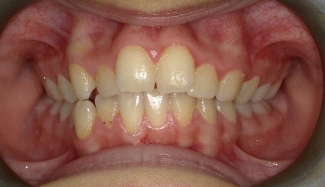 youth crossbite before 1