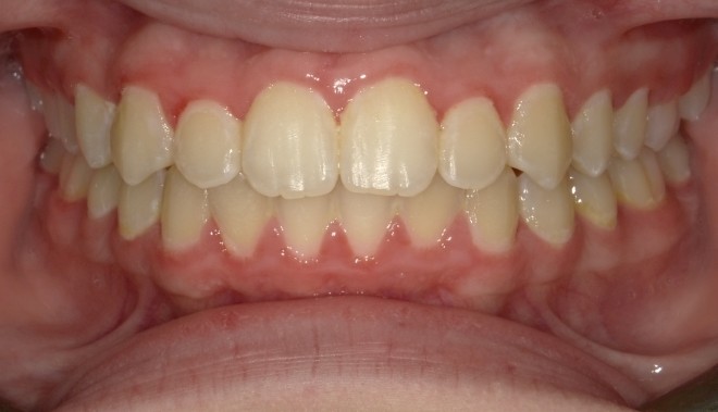 youth-crowding-1-after