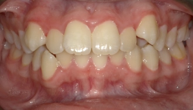 youth-crowding-1-before