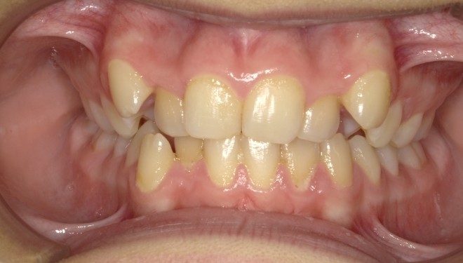 youth-crowding-2-before