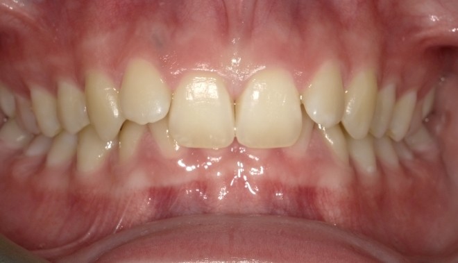 youth-overbite-1-before